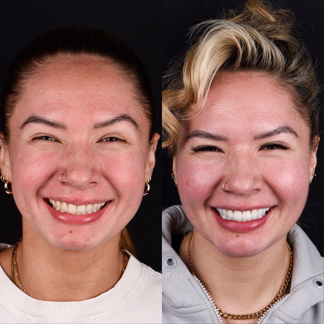 Top teeth porcelain veneers. Porcelain veneers before and after. Beverly Hills cosmetic dentist. Beverly Hills cosmetic dentistry. Los Angeles Hollywood smile. Los Angeles cosmetic dentist. Los Angele