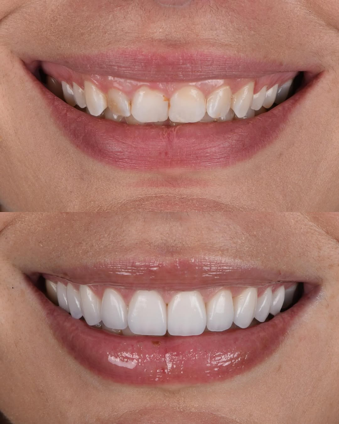 Instagram post by Dr. Dani Benyaminy: Stunning smile transformation with 10 custom porcelain veneers and a laser-assisted gum lift, achieving ideal symmetry, natural translucency…
