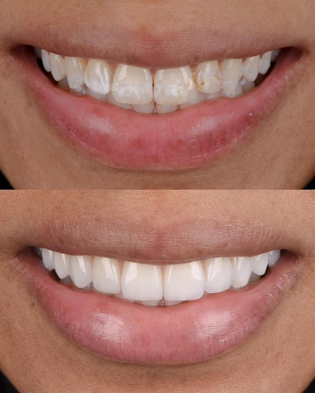 Instagram post by Dr. Dani Benyaminy: Fluorosis stains can diminish the natural beauty of a smile, but with the right approach, transformation is possible. By carefully designing…