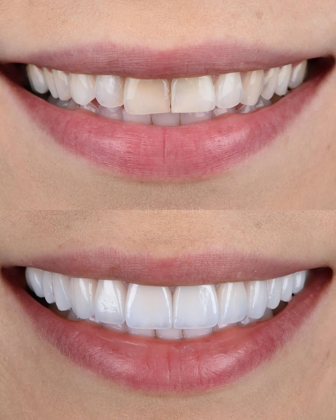 Instagram post by Dr. Dani Benyaminy: Using a combination of porcelain veneers and crowns to enhance the upper 12 teeth in this case. Two previously root canal–treated teeth had …