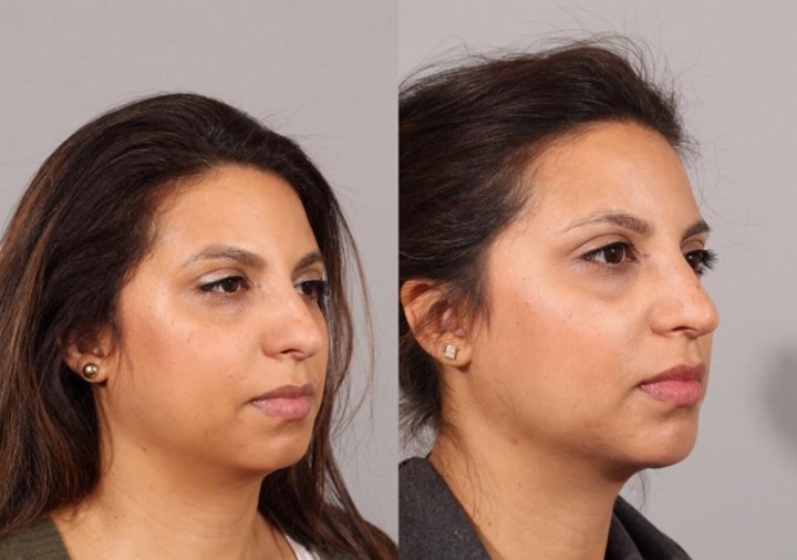Instagram post by Dr. Daniel A. Barker: Harmony and balance. ✨ In addition to a dorsal lump reduction for this patient, we also added a chin implant to lengthen the face and streng…