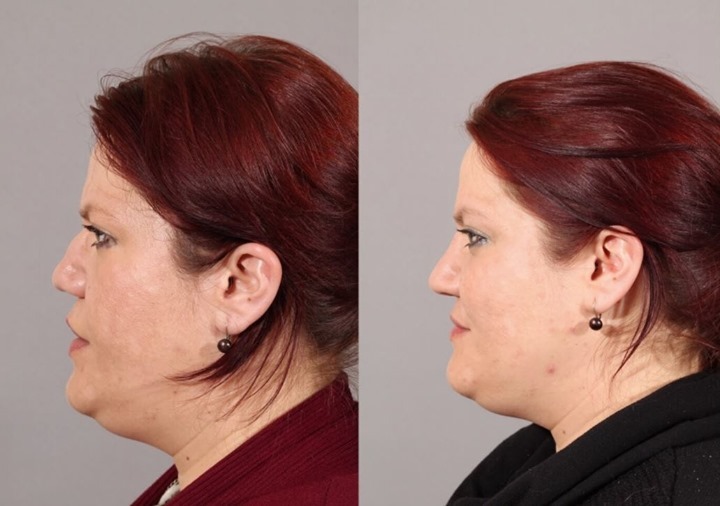 Instagram post by Dr. Daniel A. Barker: A rhinoplasty before & after that will turn heads! This rhinoplasty was done using the rib graft technique, which utilizes the patient's own…
