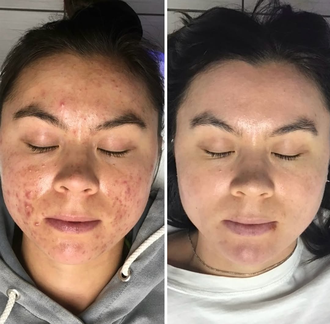 Instagram post by Dr. Daniel Behroozan: Happily Ever After Acne Journey Our patient was preparing for her upcoming wedding and we were on a mission to get her that perfect bridal s…