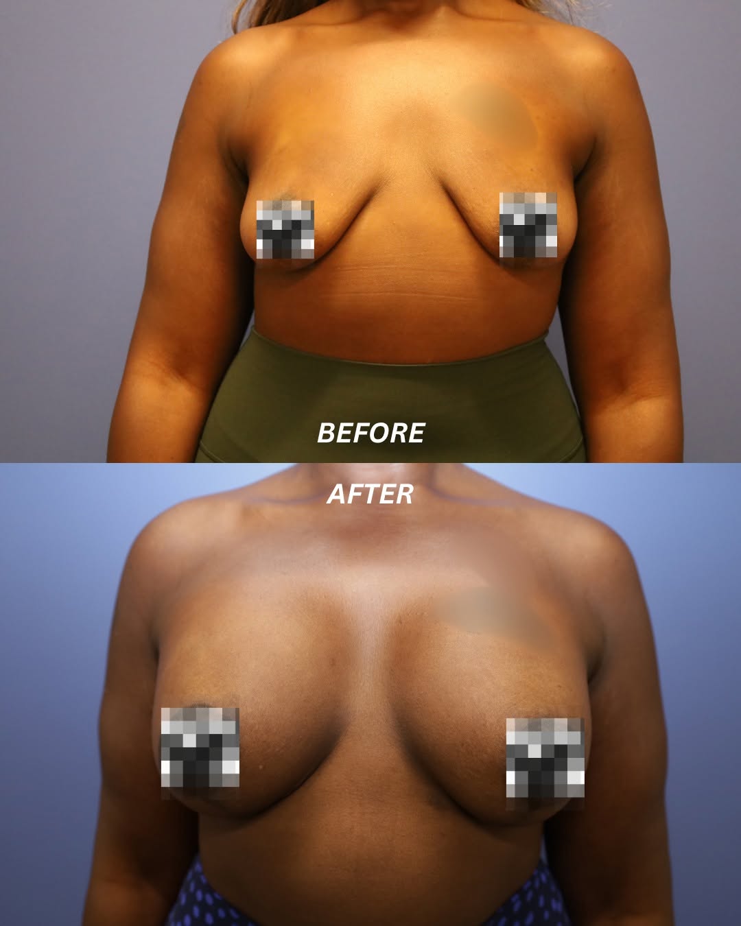 Instagram post by Dr. Daniel Bortnick: 8 months post op: mastopexy with breast augmentation. 🔍 A breast lift repositions the breast and nipple to a more youthful position, while …