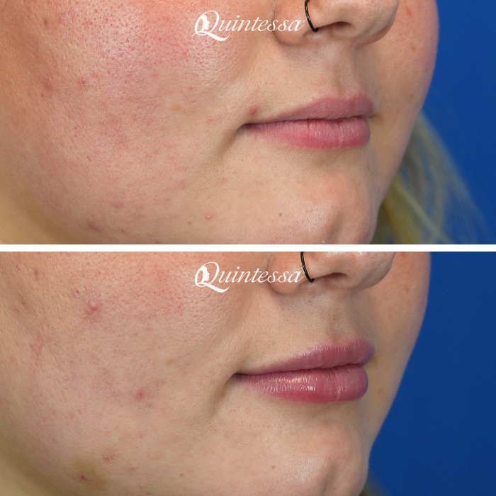 Instagram post by Dr. Daniel Butz: Subtle, natural, and oh-so-pretty! ✨ Our gorgeous client already had stunning features, but wanted her lips to complement her smile a bit mo…