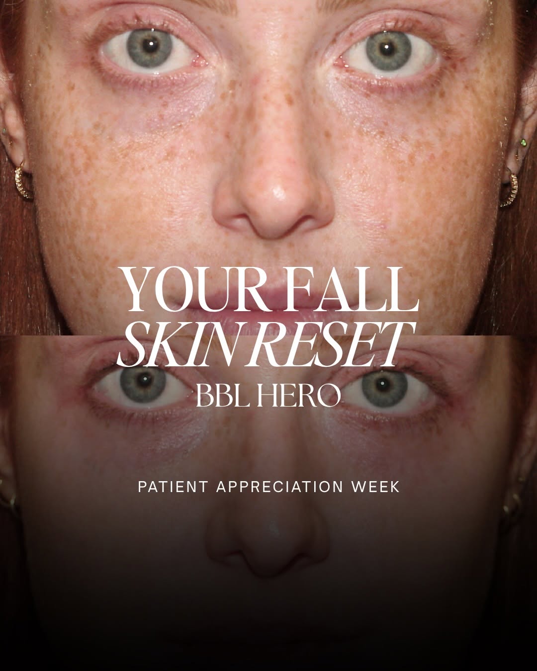 Instagram post by Dr. Daniel E. Rousso: Sun spots, redness, uneven skin tone? BBL may be your answer. ✨ BBL (BroadBand Light) is a light-based treatment that targets common signs o…