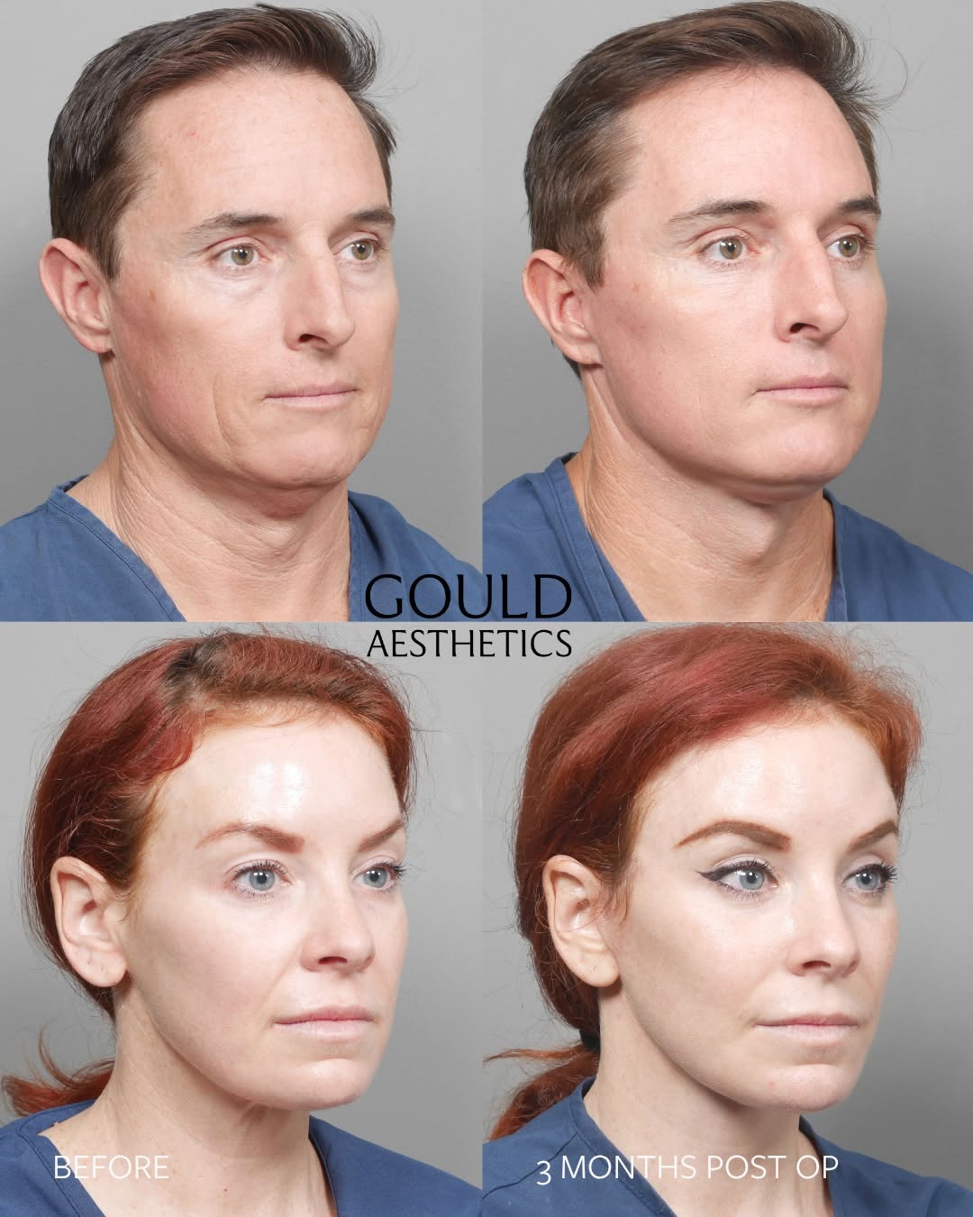 Instagram post by Dr. Daniel J. Gould: Our married couple, Matthew and Victoria, had their deep plane face lifts 30 days apart. This is both of them at three months post op. 42 an…