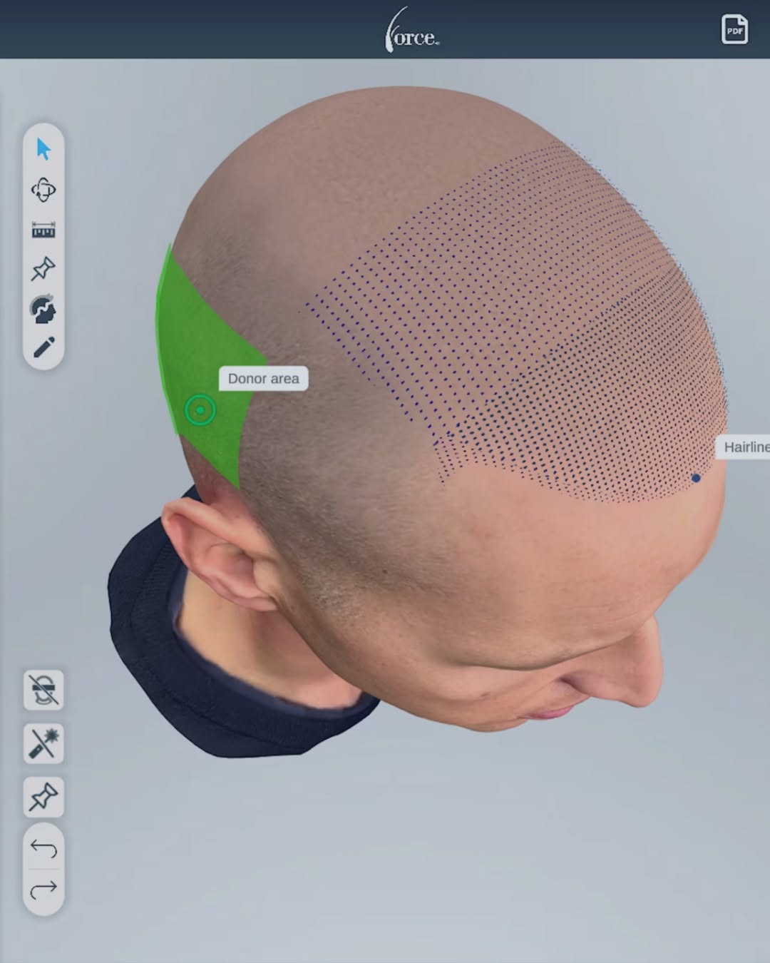 Instagram post by Dr. Daniel J. Lee: See your results before the procedure even begins. 🤩 Using advanced 3D technology, Dr. Lee designs a custom hairline tailored to your facia…