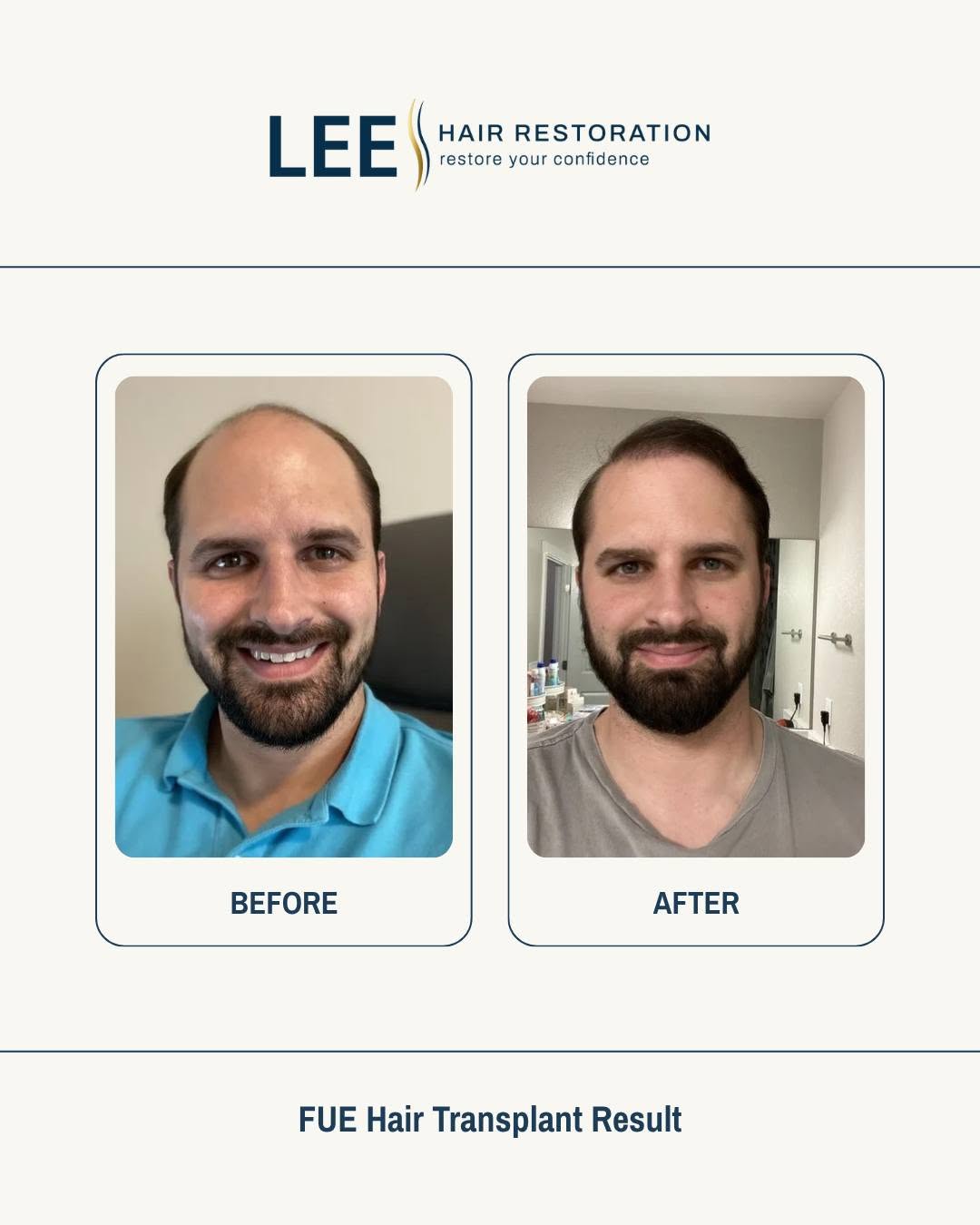 Instagram post by Dr. Daniel J. Lee: A natural hairline. Balanced density. Confidence that shows. This is what a well-planned FUE hair transplant looks like at Lee Hair Restorat…