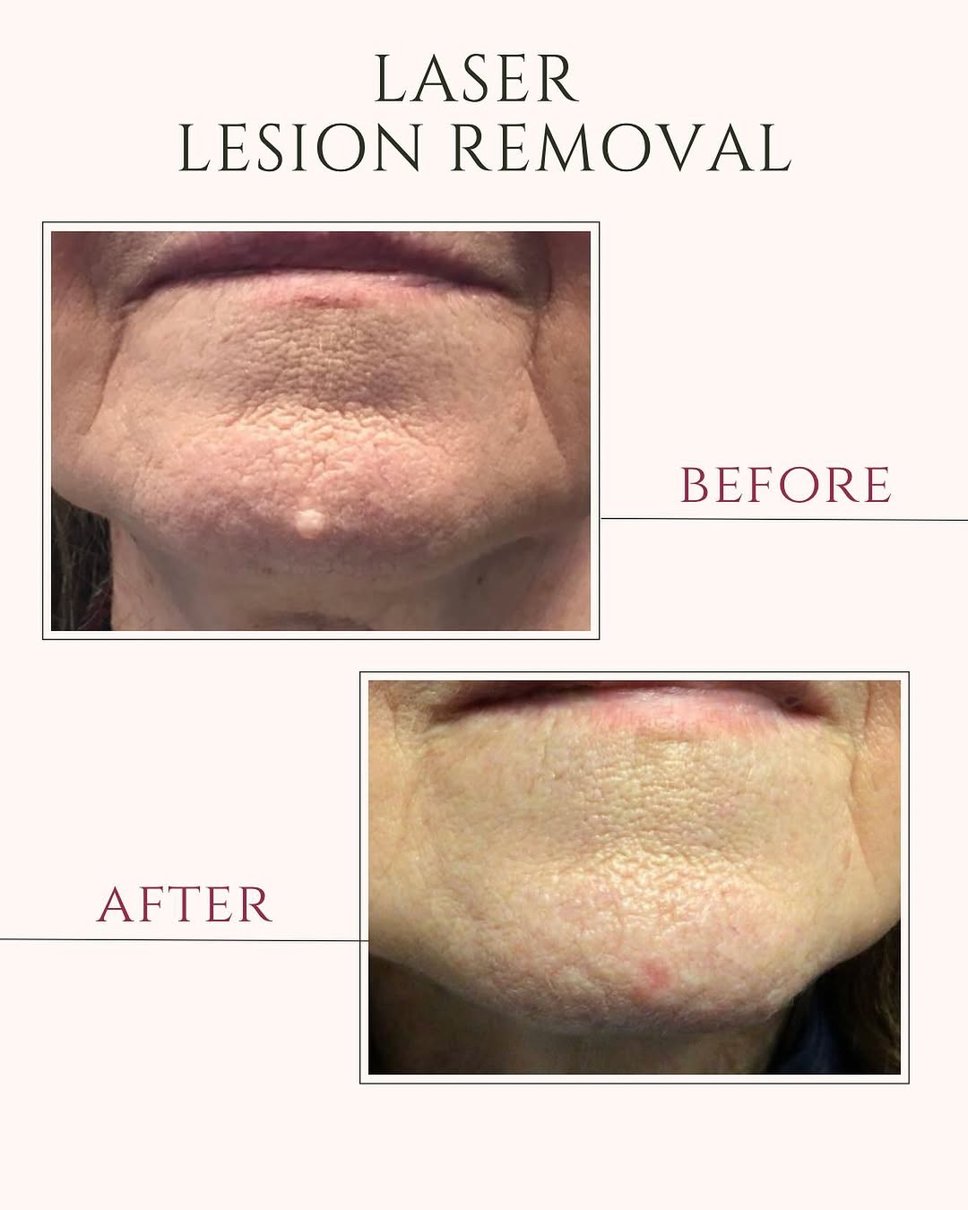 Instagram post by Dr. Daniel J. Ritacca: Say BYE BYE BYE to unwanted lesions👋 Looking to remove a lesion like this one ? But want to avoid surgery…. Not a problem!! With our lasers…