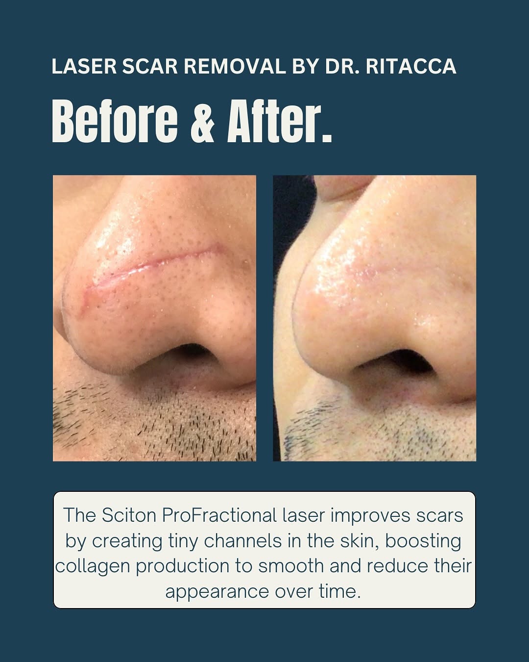 Instagram post by Dr. Daniel J. Ritacca: Before & After ✨ Dr. Ritacca used the Sciton ProFractional laser to help remove this scar, revealing smoother, more even skin. The results s…