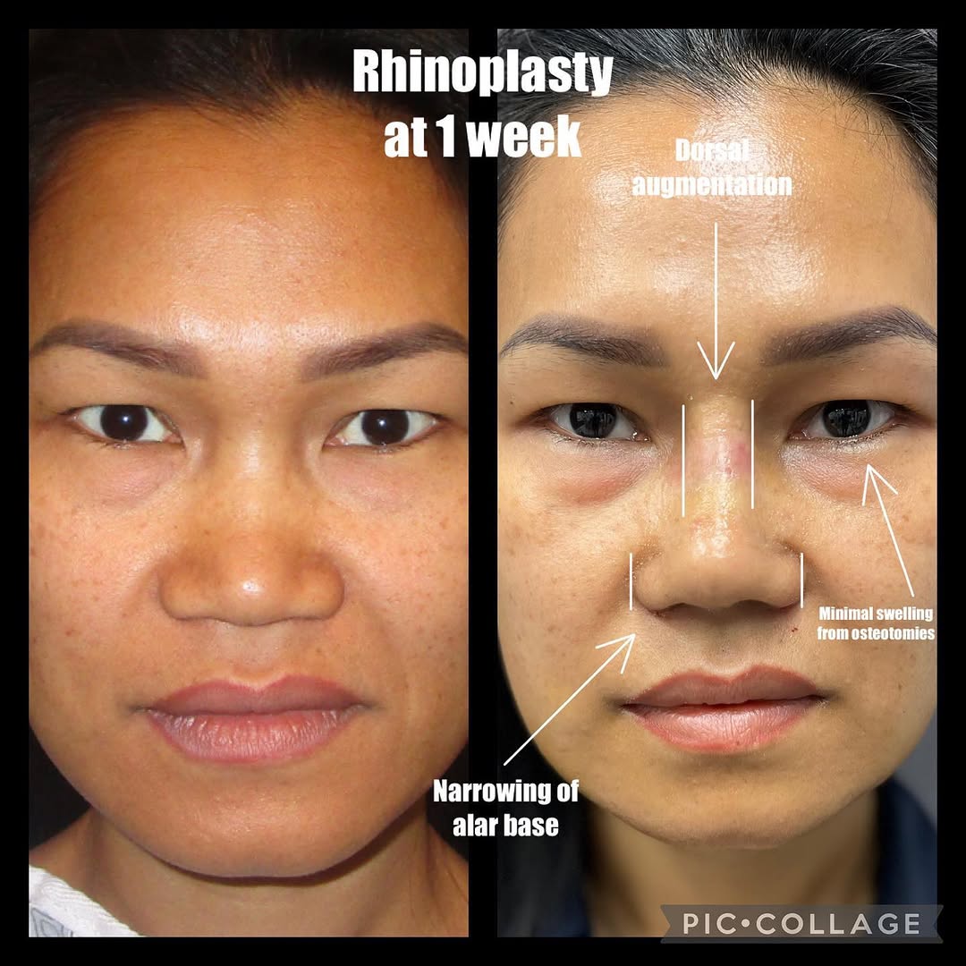 Instagram post by Dr. Daniel Kirk: This patient presented to us with the main concern that she couldn’t wear glasses because she lacked a nasal bridge. She also did not like t…