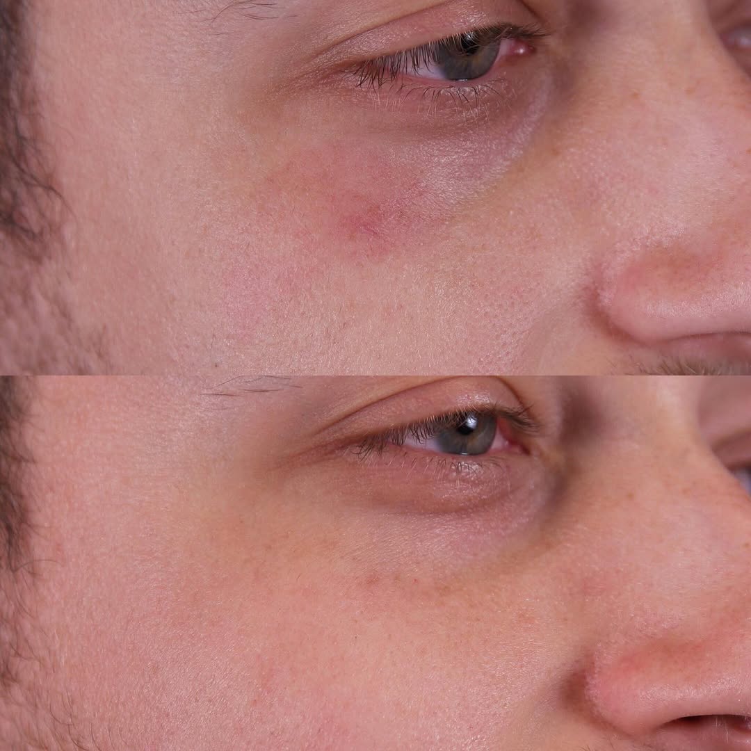 Instagram post by Dr. Daniel P. Friedmann: I love lasering away red spots (spider angioma) on the face! #laser #laserexpert #pulseddyelaser #vbeam #PDL #intensepulsedlight #IPL #world…