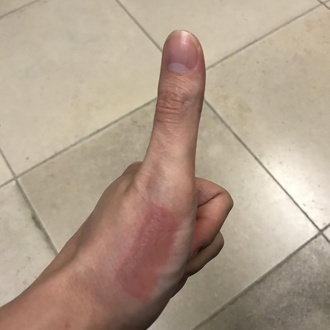 Instagram post by Dr. Daniel P. Friedmann: Thumbs up for IPL #playingwithdevices #accidentshappen #intensepulsedlight #photofacial #ilovelasers #worldsbestdermatologist