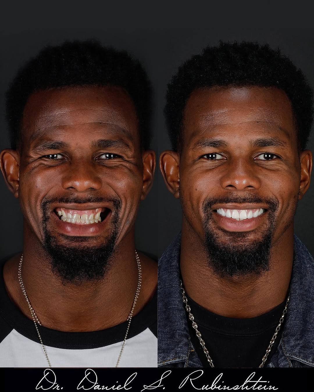 Instagram post by Dr. Daniel Rubinshtein, DDS: LIFE CHANGING. WHO WANTS A SMILE MAKEOVER NEXT ?? @jaishaunwhite 🥶