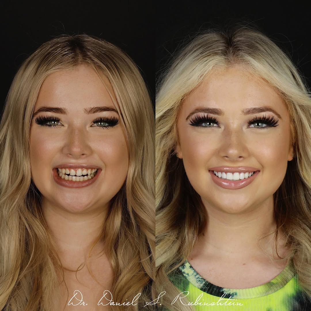 Instagram post by Dr. Daniel Rubinshtein, DDS: NO CAPTION NEEDED. WHO IS NEXT?? #GUMLIFT #VENEERS 🤩 GUMLIFT BY @nyperiodontist // @jadeblakee_