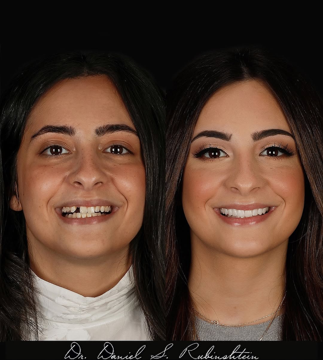 Instagram post by Dr. Daniel Rubinshtein, DDS: Just in case you forgot what I do… here’s your reminder. Who needs a smile makeover next? 🦷😃 #cosmeticdentistry 📸 @onyskophotography