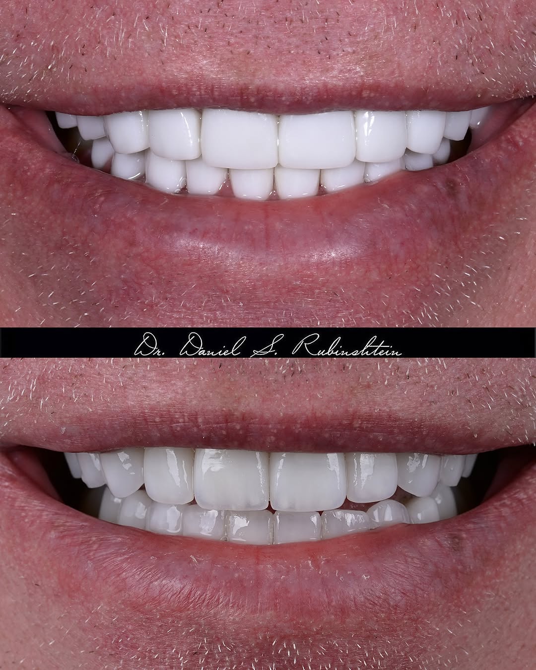 Instagram post by Dr. Daniel Rubinshtein, DDS: Same person. Two different styles of porcelain. We wanted to put life into the teeth !!! Can you spot the difference? 👀 #PorcelainVeneers #…