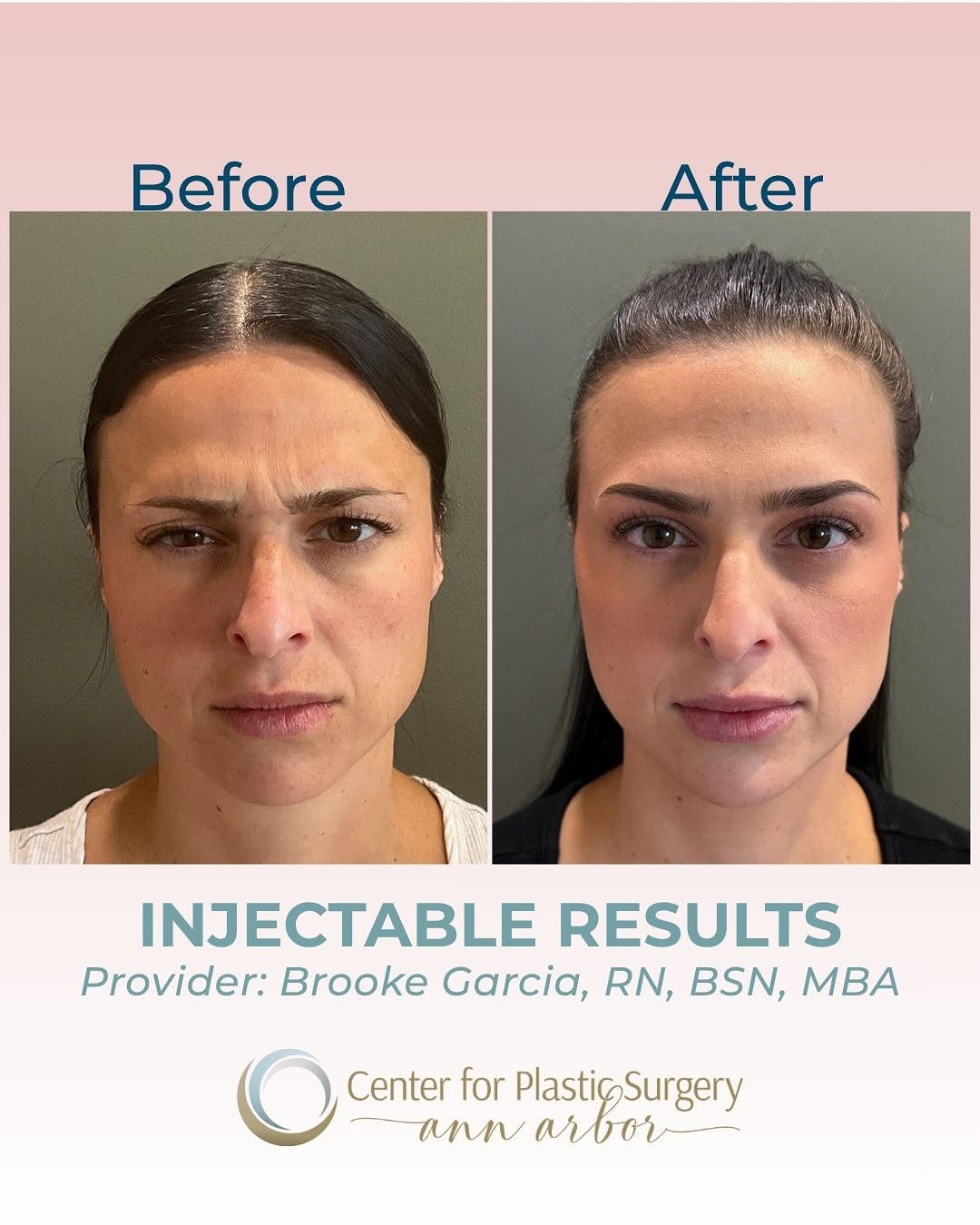 Instagram post by Dr. Daniel Sherick: A little Botox® + a little filler = a beautifully balanced refresh ✨ This patient’s treatment with Nurse Injector Brooke Garcia focused on s…