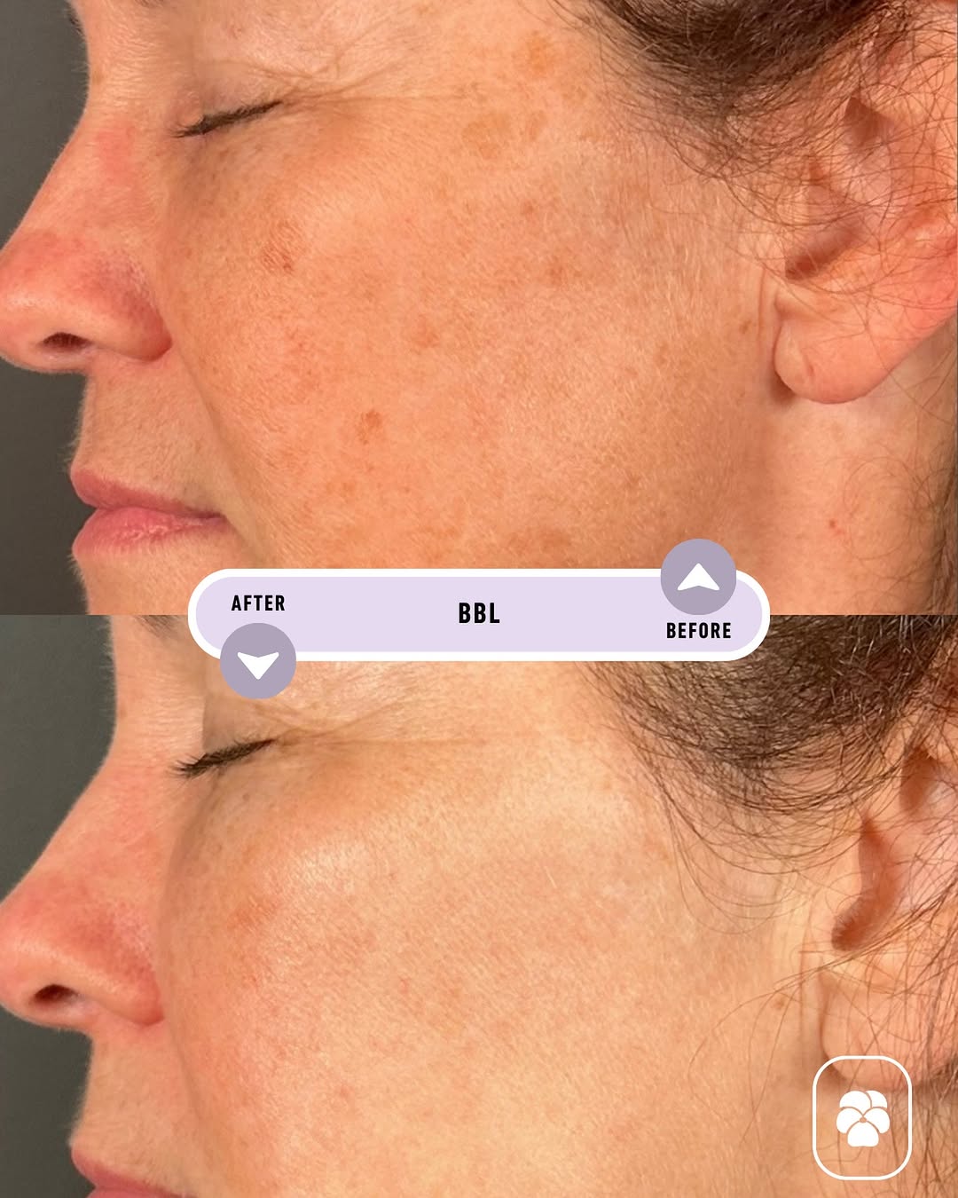 Instagram post by Dr. Daniel Straka: Sun damage doesn’t have to stay visible. BBL uses targeted light energy to help address visible pigmentation, dark spots, and uneven tone fo…