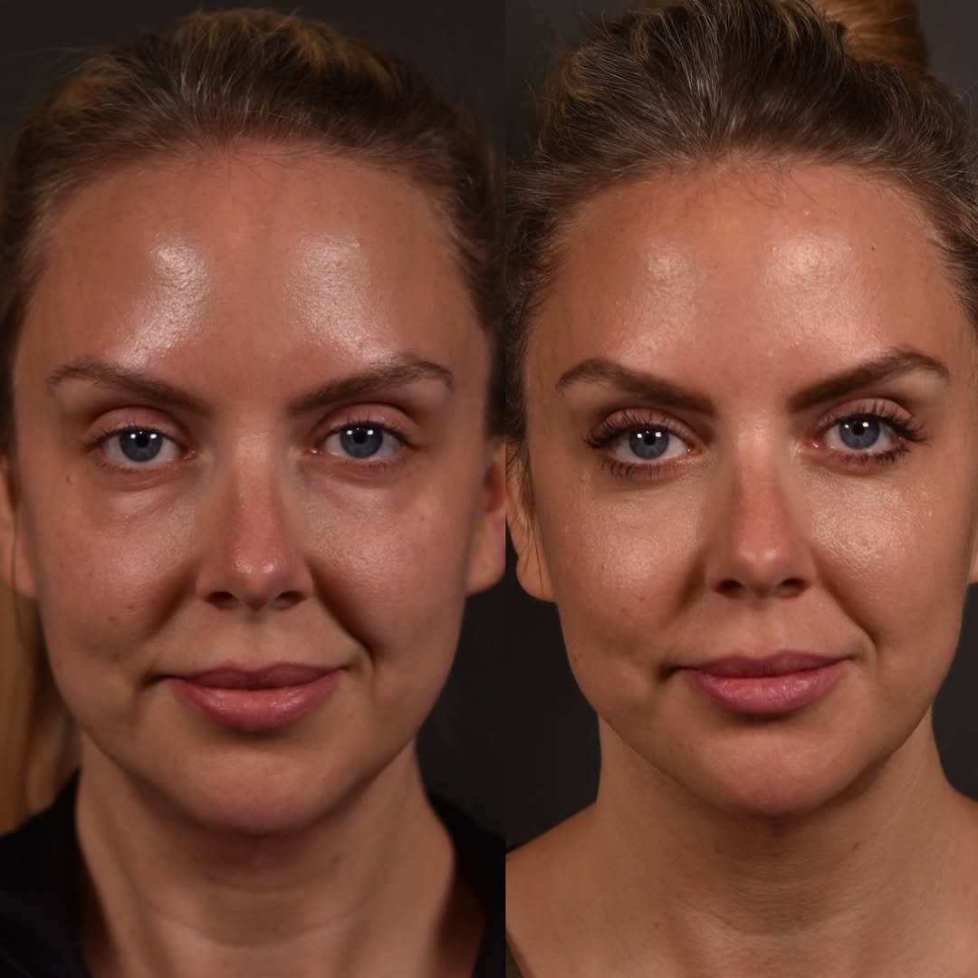 Instagram post by Dr. Daniel Straka: Before and 5 months after lower blepharoplasty with fat repositioning, and laser resurfacing. The deadly combo for under eye bags and dark c…