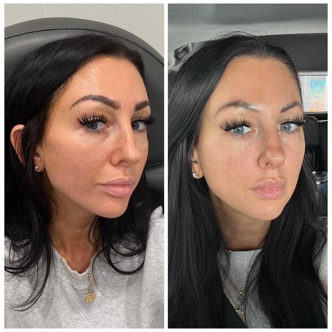 Instagram post by Dr. Daniel Thomas: Before → After Lateral midface volume restoration ✨ We restored lost volume in the lateral cheeks to rebuild structure, soften shadows, and …