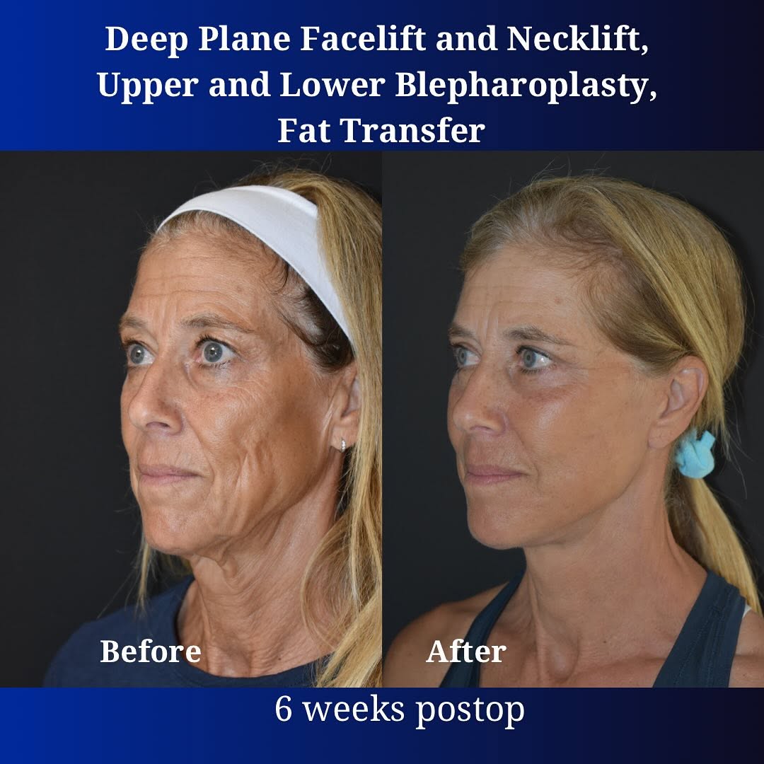 Instagram post by Dr. Daniela Burchhardt: 6 week postop result from Deep Plane Face and Neck Lift paired with Fat Transfer and Upper and lower Blepharoplasty (Eyelid Lift). A big tha…