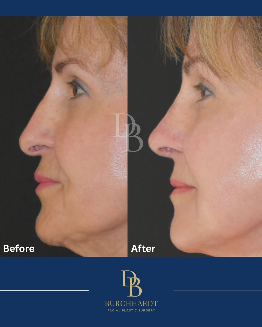 Instagram post by Dr. Daniela Burchhardt: Revision rhinoplasty: Our nose undergoes many changes overtime, including changes of aging, leading to a lack of support. Prior surgery can …