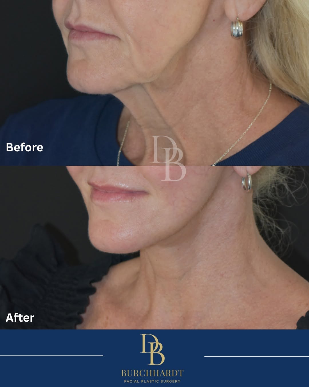 Instagram post by Dr. Daniela Burchhardt: Surgery repositions tissue that has descended due to gravity. Neck and face go hand in hand, since by reposition the descended tissue in the…