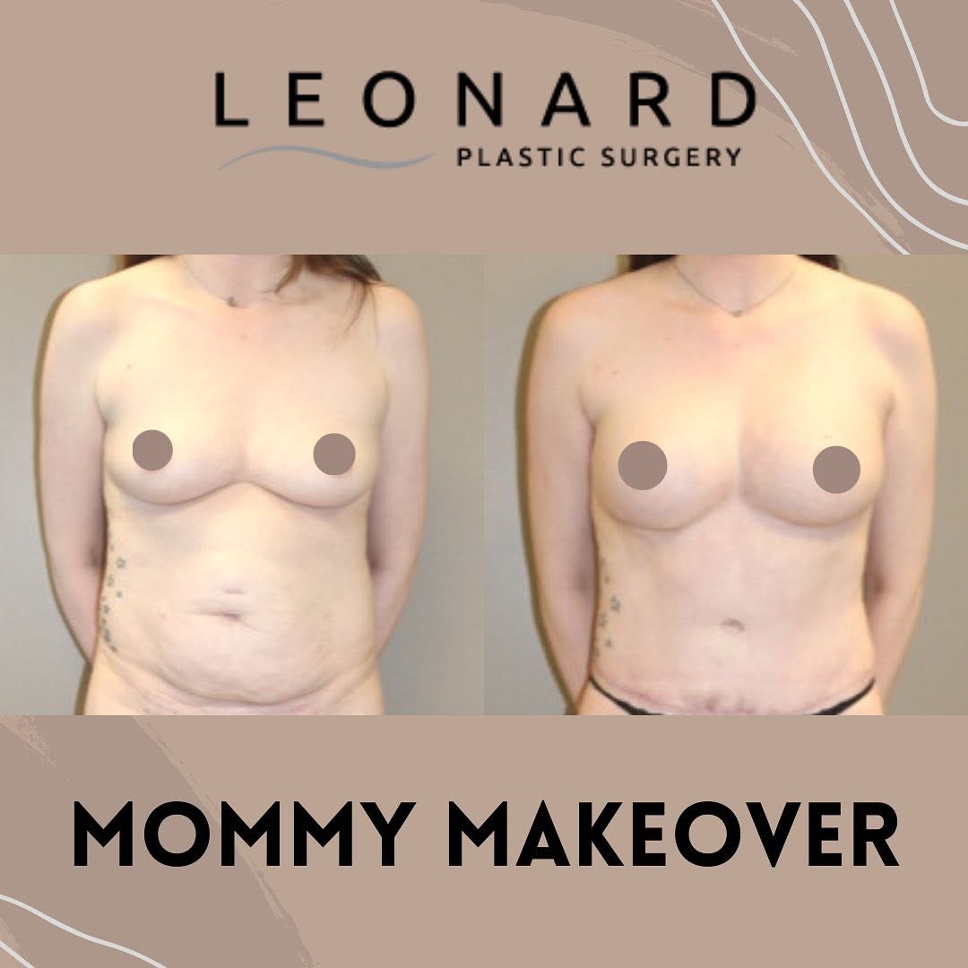 Instagram post by Dr. Dann Leonard: This petite 34-year-old patient came in to consult with the doctor about her abdomen and breasts. She had two pregnancies where she gained s…