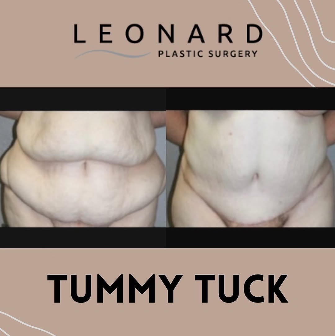 Instagram post by Dr. Dann Leonard: After a lifelong history of morbid obesity, this patient took charge of her life and underwent bariatric surgery. She had an extremely succe…