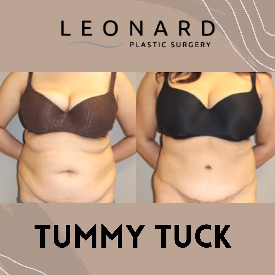 Instagram post by Dr. Dann Leonard: Having 3 children and a 60 lb weight gain during these pregnancies, this 37-year-old patient worked hard to lose her baby weight and came to…