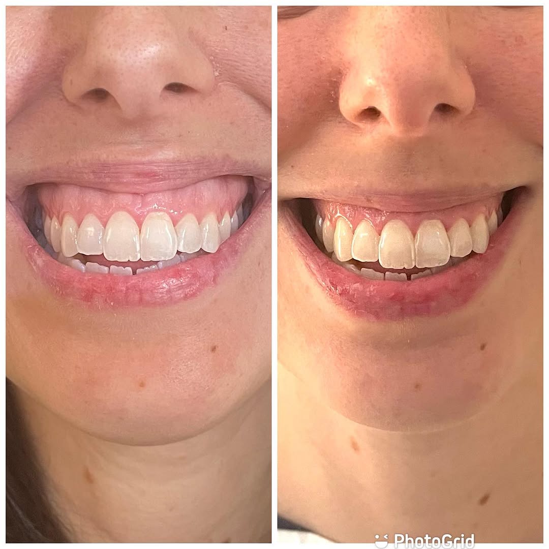 Instagram post by Dr. Darice W. Fadeyi: A beautiful smile is a complex interplay between gingiva, healthy teeth and lips - all working in symmetrical animation. A smile with excess…
