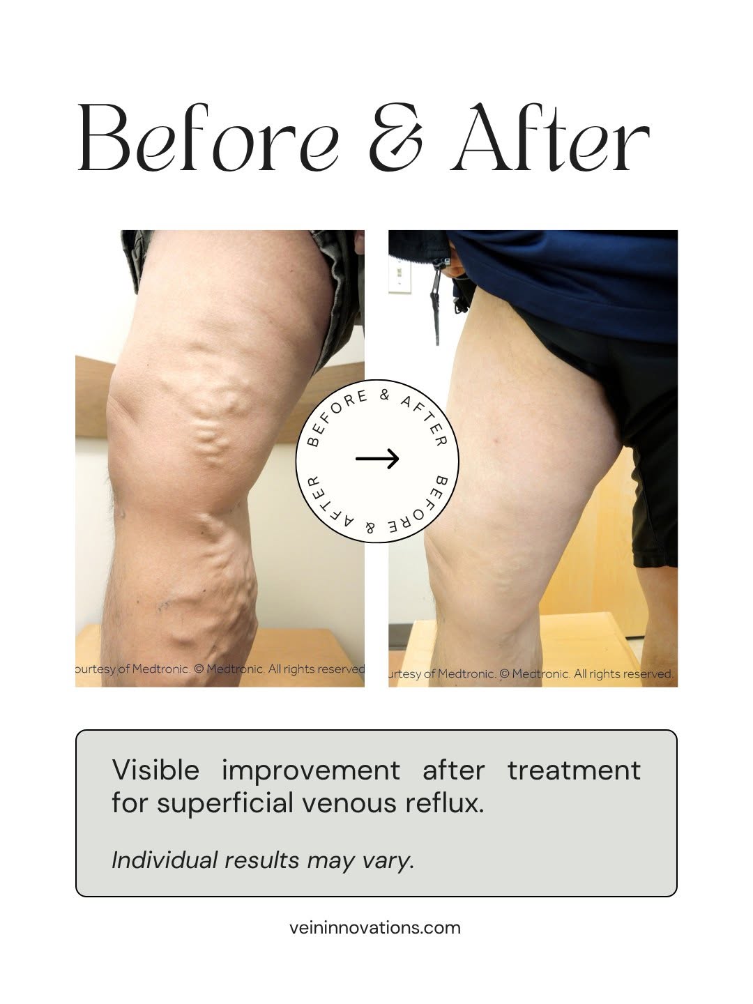 Instagram post by Dr. Darrell Caudill: Visible results are only part of the story. People who treat vein disease report less pain, less swelling, and legs that finally feel the wa…