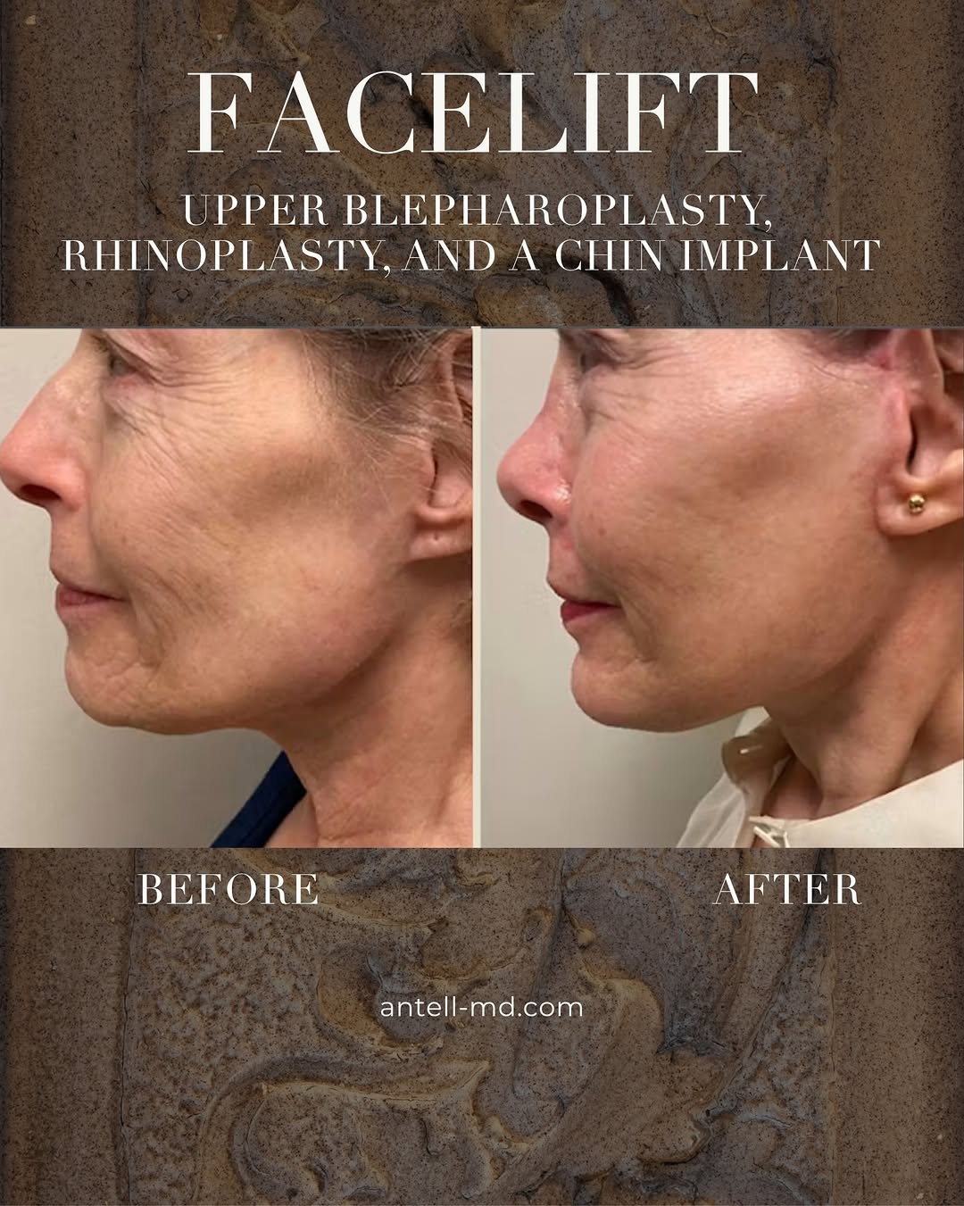 Instagram post by Dr. Darrick E. Antell: A comprehensive facial rejuvenation is never about changing who you are. It’s about restoring harmony. For this patient, we combined a facel…