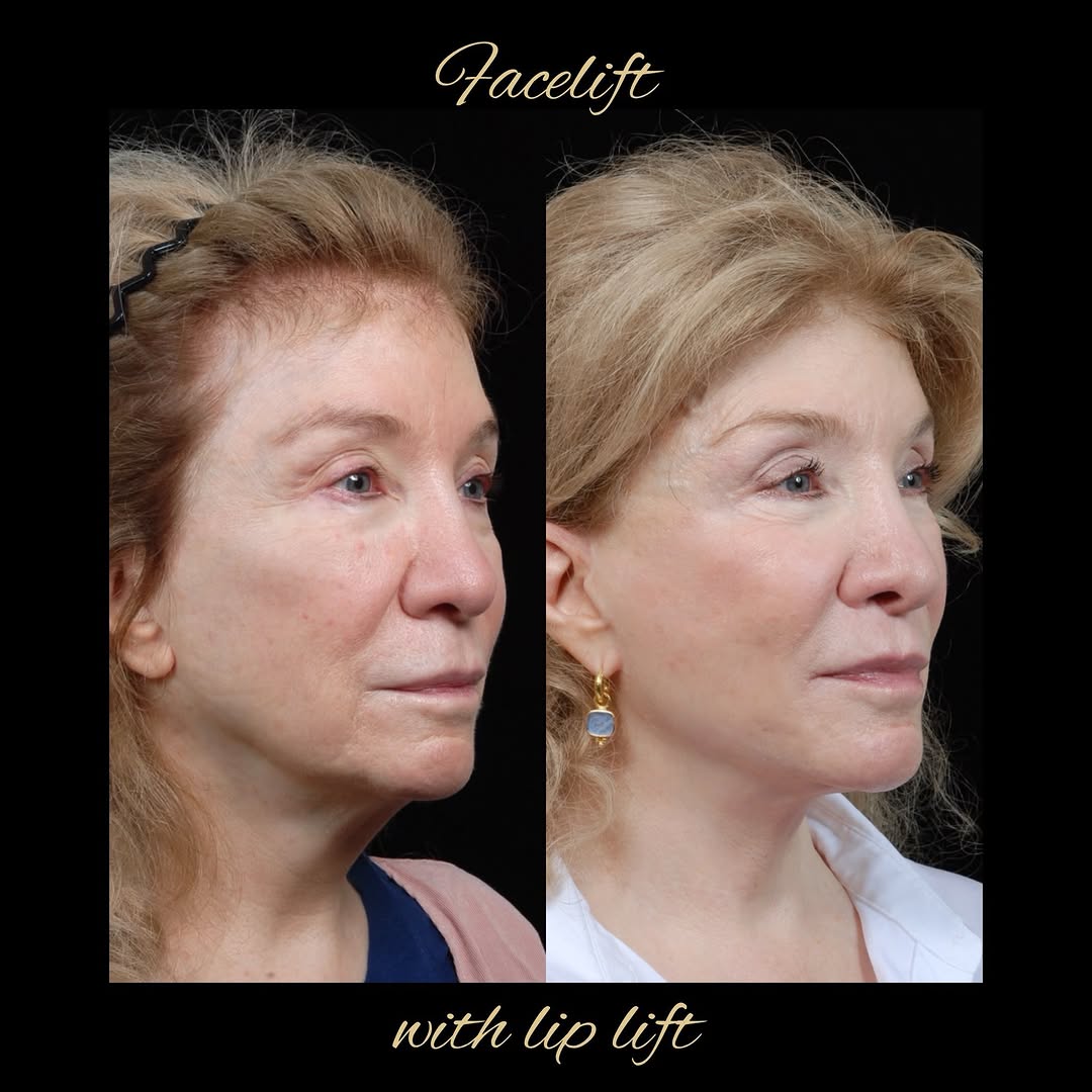 Instagram post by Dr. David A. Hidalgo: Facelifts can be done successfully more than once, particularly when well done the first time. Fresh and natural results can be achieved wit…