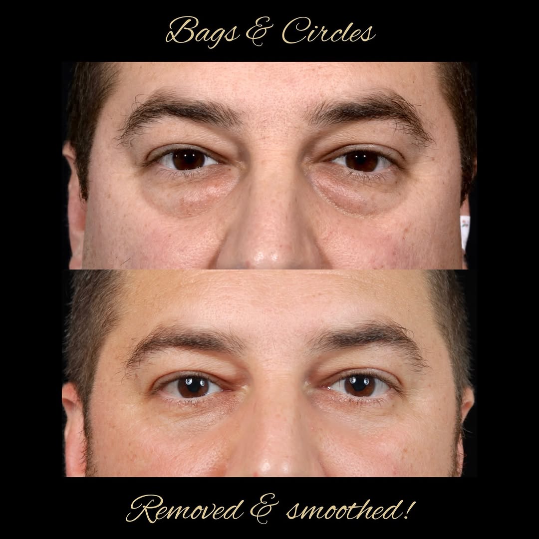 Instagram post by Dr. David A. Hidalgo: See the previous reel for a discussion on key issues involved in planning lower eyelid rejuvenation surgery. Some cases only require fat rem…