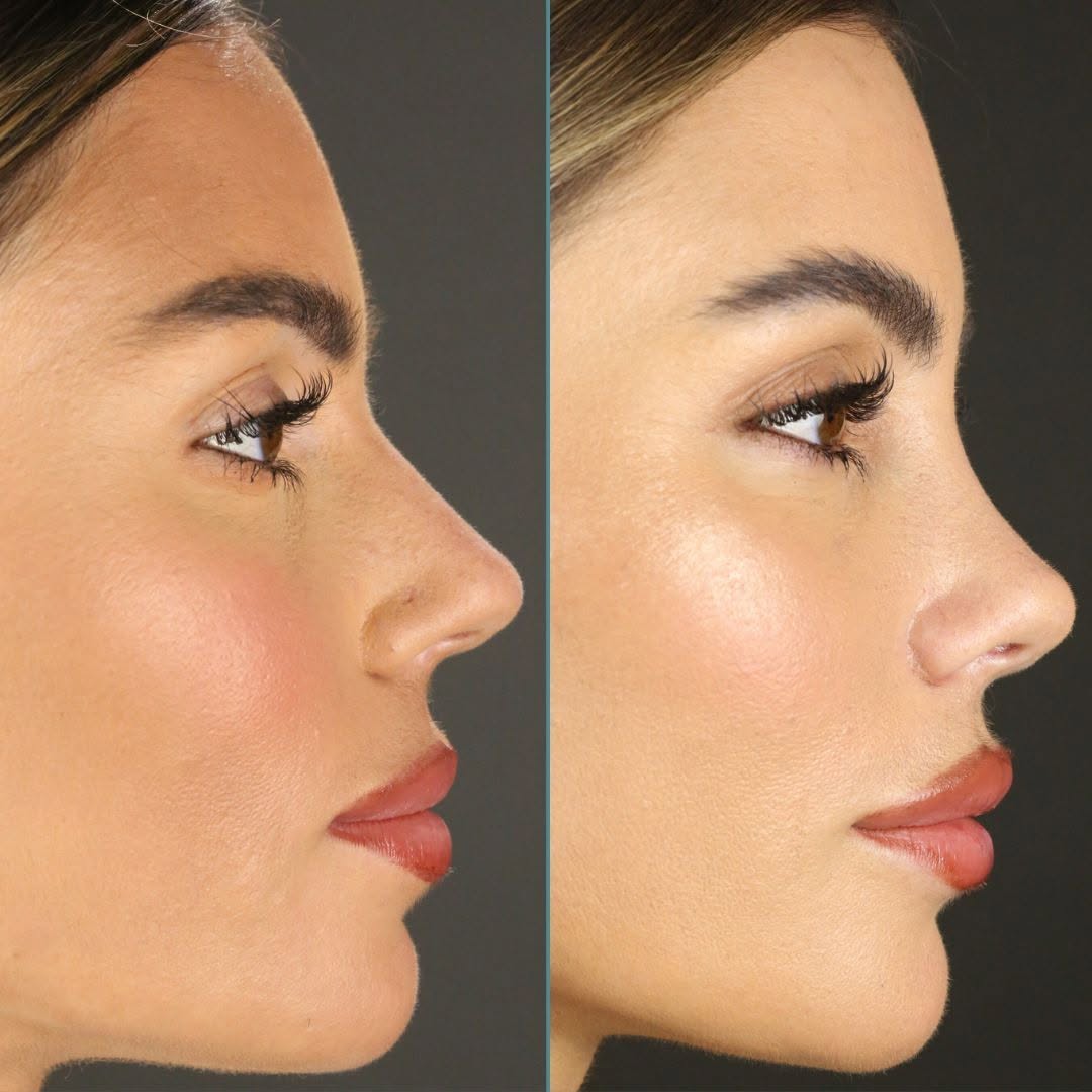 Instagram post by Dr. David A. Newman: ✨ Rhinoplasty Update! ✨ @enna_nutschell is only 2 weeks out from her rhinoplasty with Dr. Newman, and she’s already looking absolutely fabul…