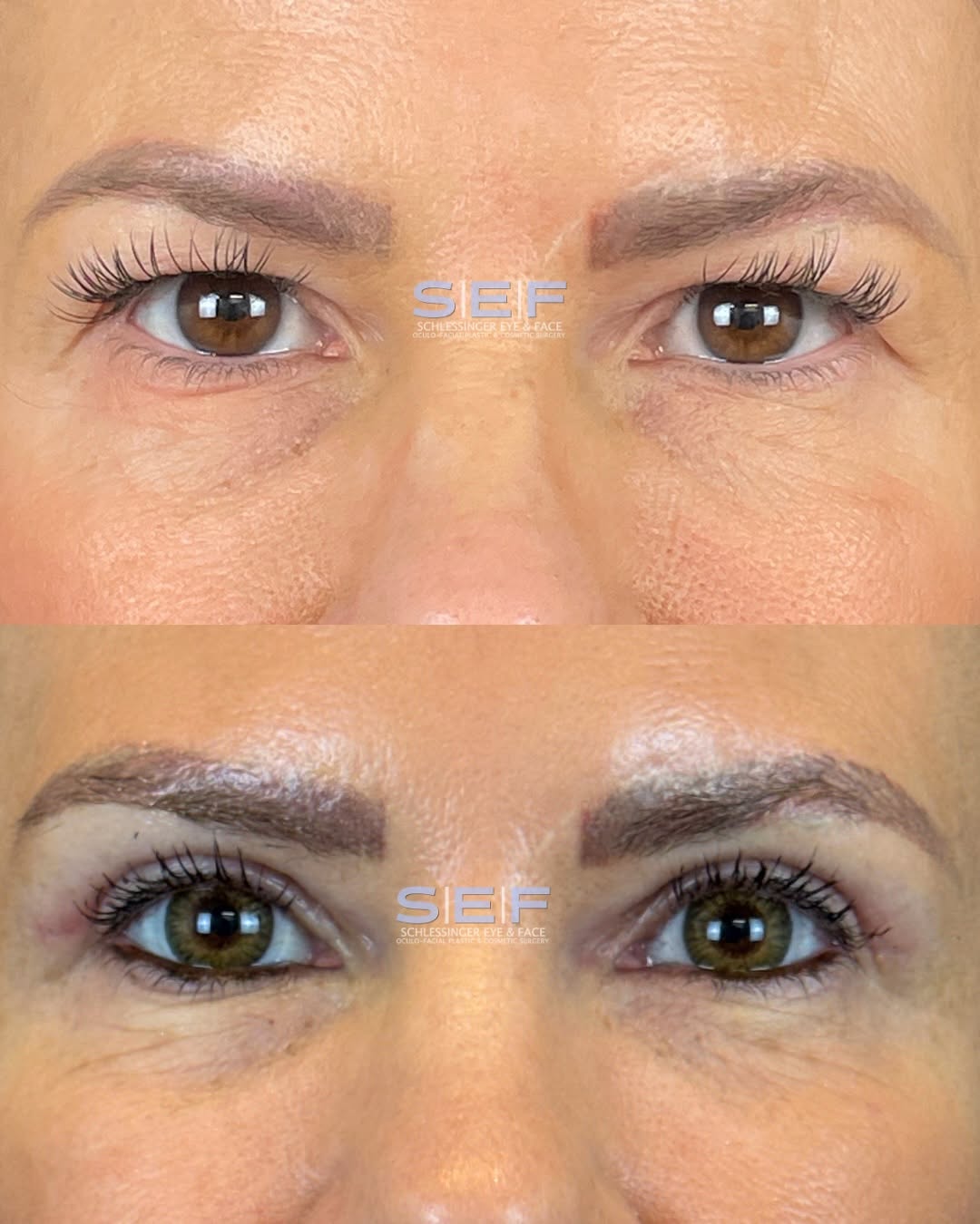 Instagram post by Dr. David A. Schlessinger: Blepharoplasty isn’t just for your 50s, 60s, or 70s. 👀 Some people naturally develop excess upper eyelid skin much earlier, whether because…