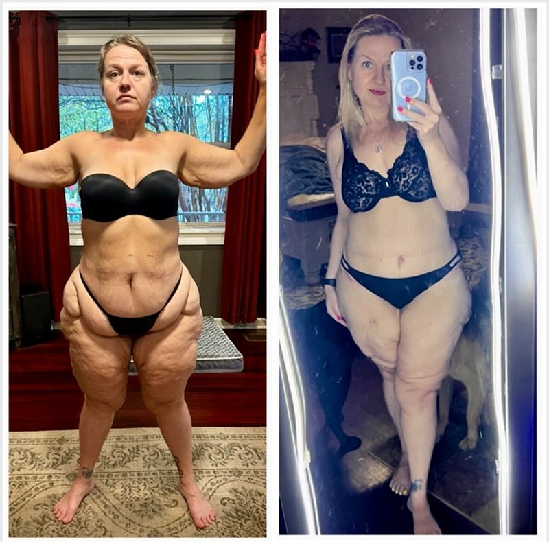 Instagram post by Dr. David Azouz: This amazing patient’s lipedema surgical journey with Dr. Solomon Azouz isn’t completed yet, but…. 😍 This is what transformation looks like…