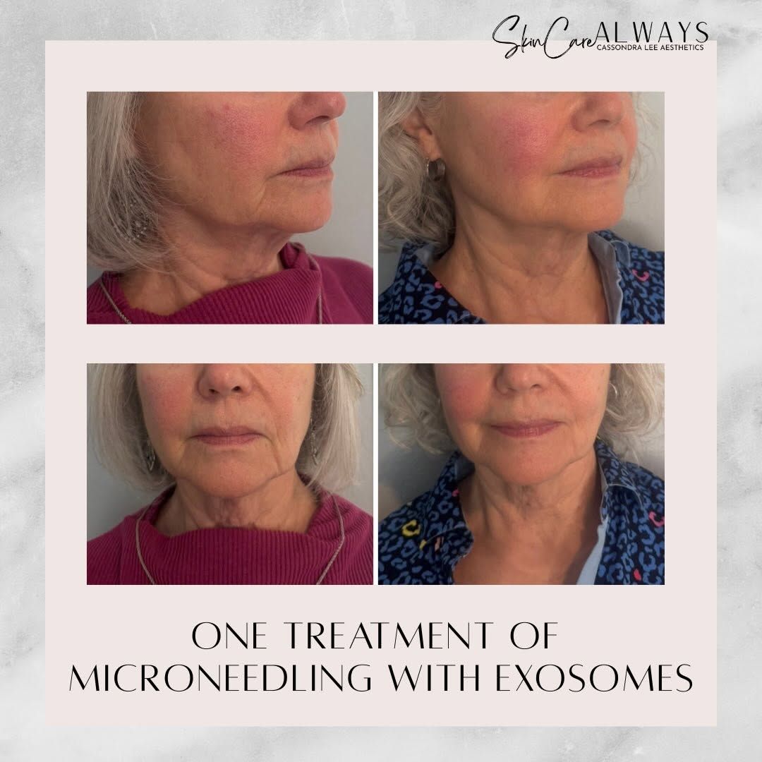 Instagram post by Dr. David Azouz: Amazing results after just one microneedling with exosomes treatment ✨ We love seeing such a beautiful boost in skin health and glow after a…