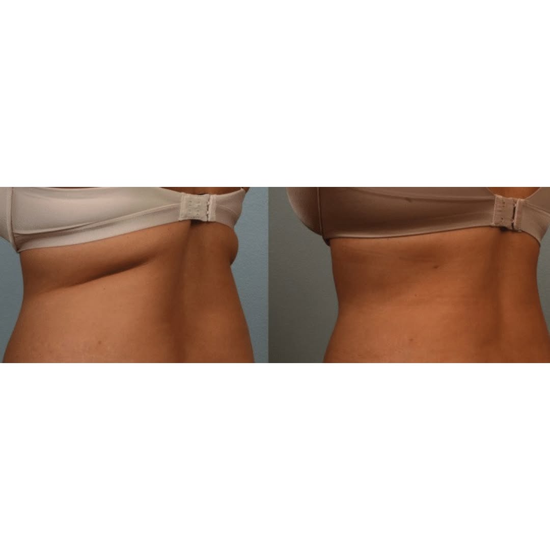 Instagram post by Dr. David Benvenuti: Tired of your bra rolls? Suction with Renuvion skin tightening is the solution! Call (949) 650-2345 for a consultation.