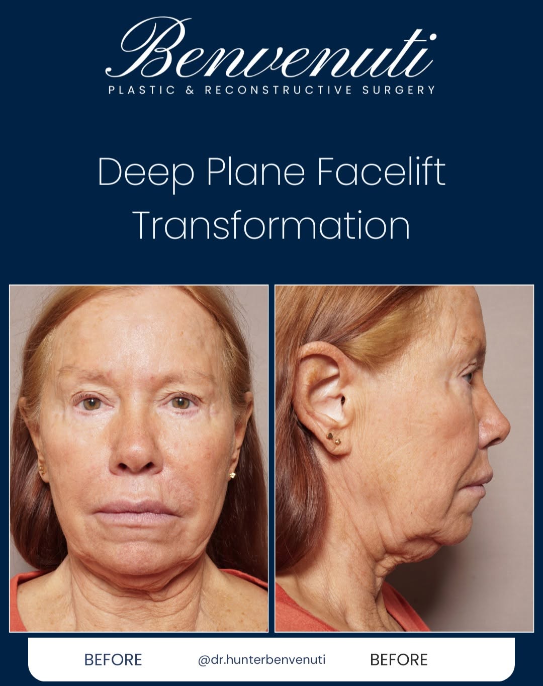 Instagram post by Dr. David Benvenuti: Unlock the Secrets of a Youthful Appearance with Deep Plane Facelift! Curious about the deep plane facelift? Here’s everything you need to k…
