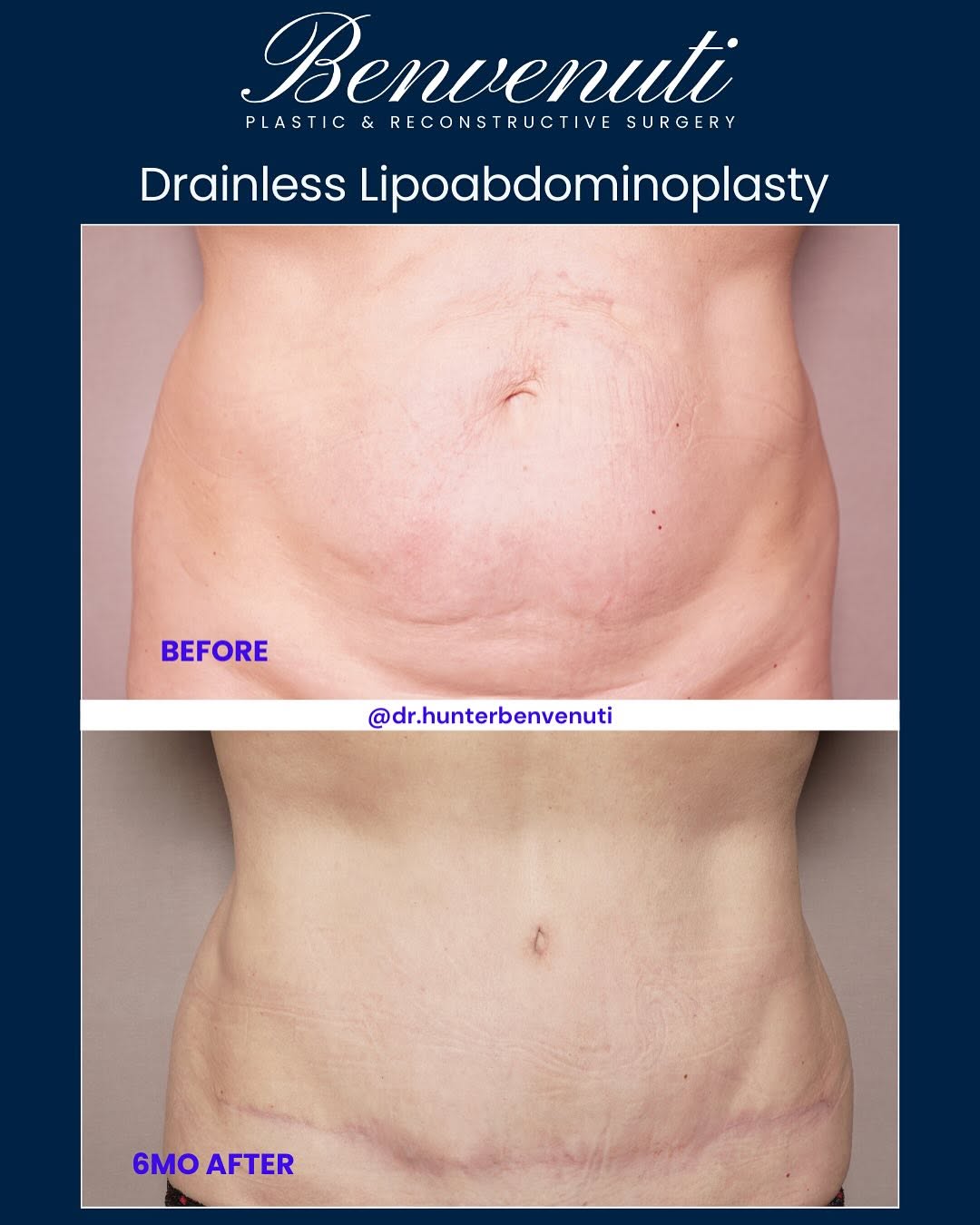 Instagram post by Dr. David Benvenuti: Before & After: Drainless Lipoabdominoplasty Transformation This modern approach combines liposuction with a tummy tuck to flatten and shape…