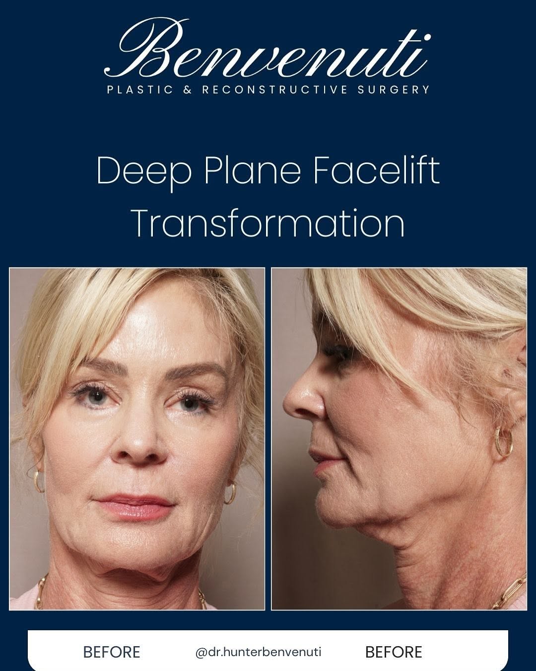 Instagram post by Dr. David Benvenuti: Another stunning transformation with the Deep Plane Facelift! Swipe to see her evolution as we turn back the clock with this revolutionary t…