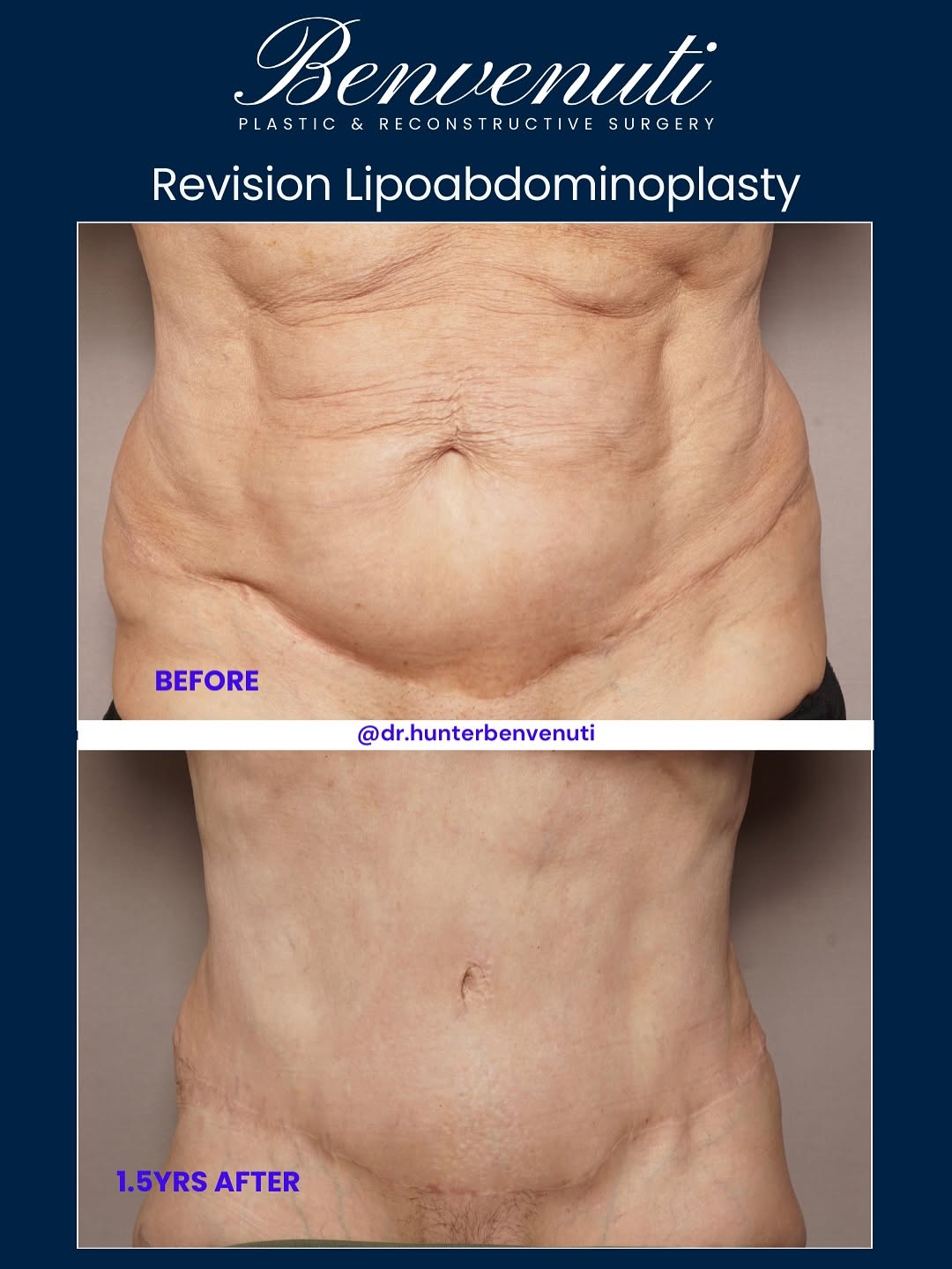 Instagram post by Dr. David Benvenuti: Revision Lipoabdominoplasty Sometimes, the first tummy tuck doesn’t give the desired results, or changes over time from scar tissue, weight …