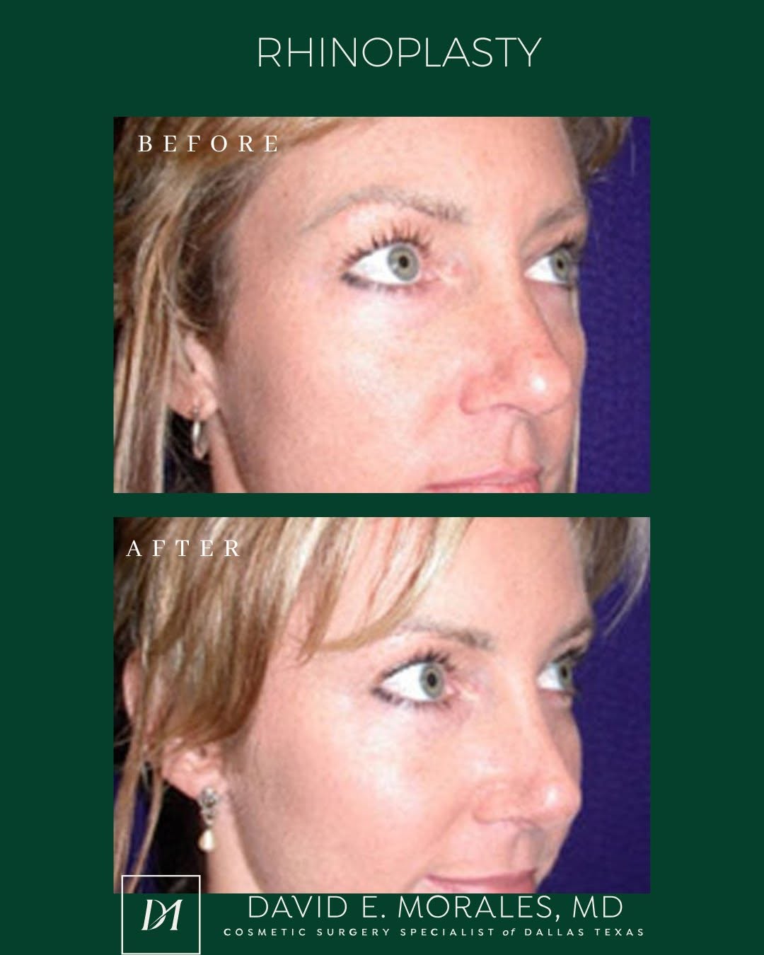 Instagram post by Dr. David E. Morales: Rhinoplasty: The best results don’t change who you are — they enhance your balance. ________________________ 📍: Dallas, TX 👨‍⚕️ Board Cert…
