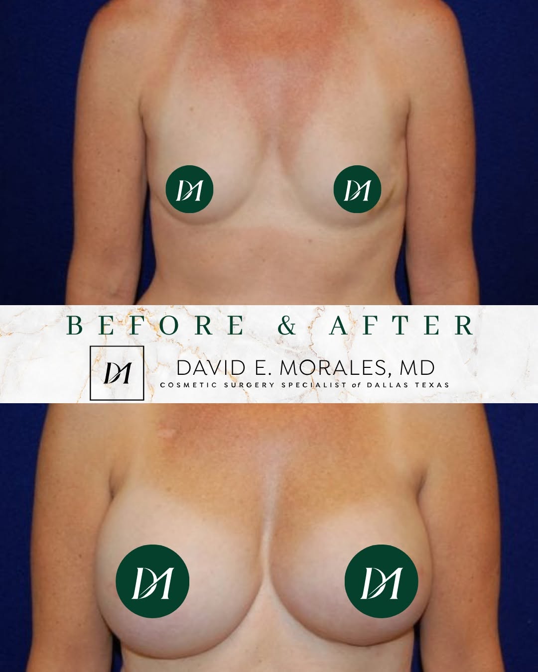 Instagram post by Dr. David E. Morales: Breast reconstruction is about more than restoring shape—it can be an important part of helping patients feel more like themselves again. Th…