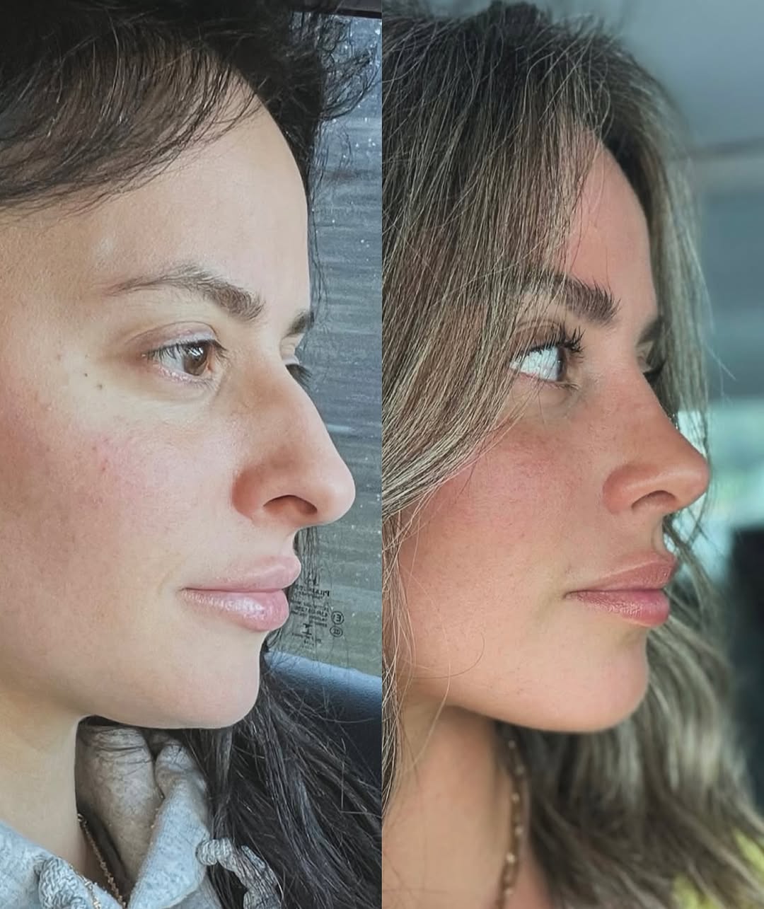 Instagram post by Dr. David Gilpin: “Getting a rhinoplasty was the best money I’ve ever spent. It didn’t just change my face, it changed my life.” A beautiful before & after re…