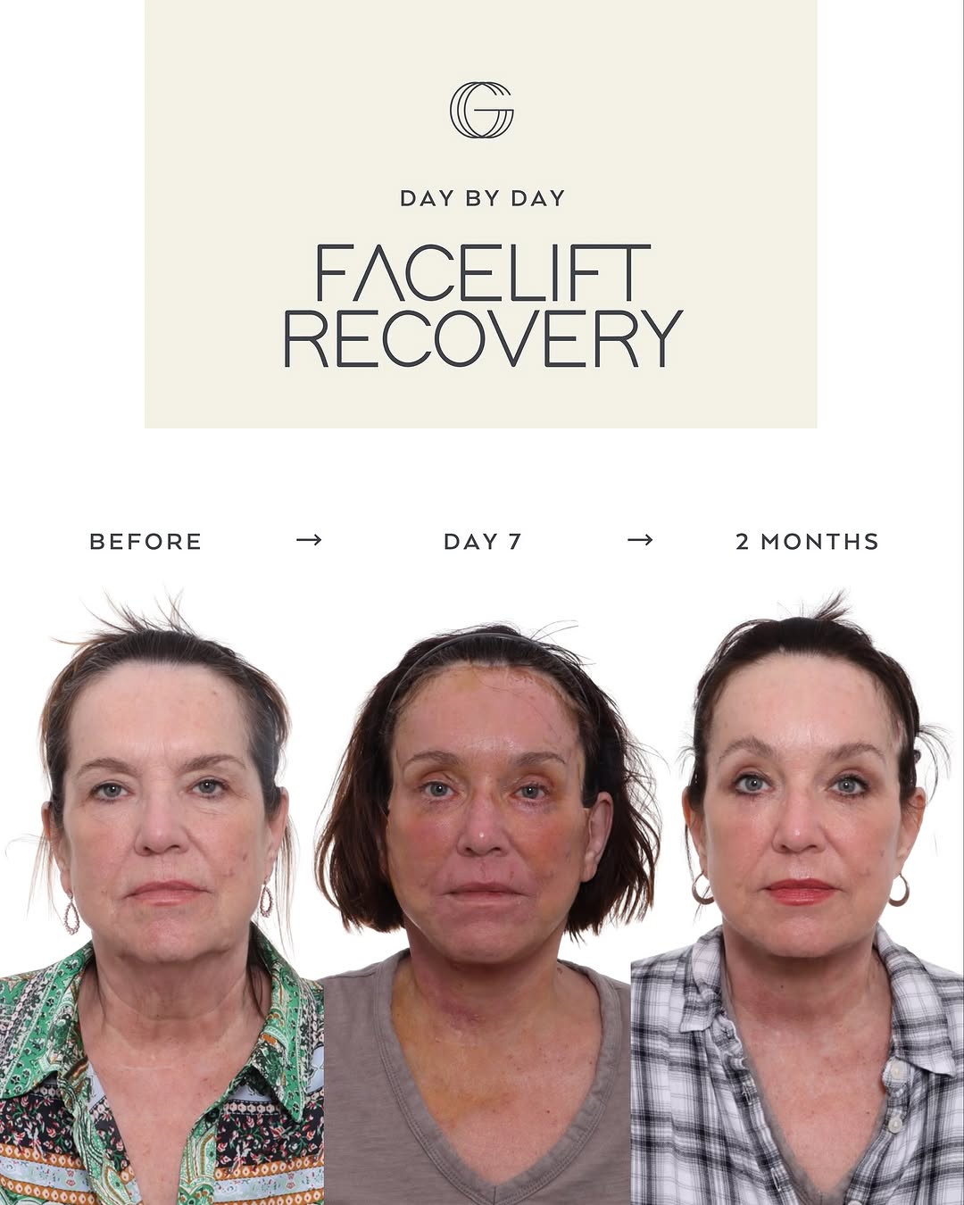 Instagram post by Dr. David Gilpin: Recovery is an essential step after a facelift — let’s walk through the process day by day! It’s normal to have some apprehension about reco…